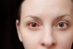 Conjunctivitis